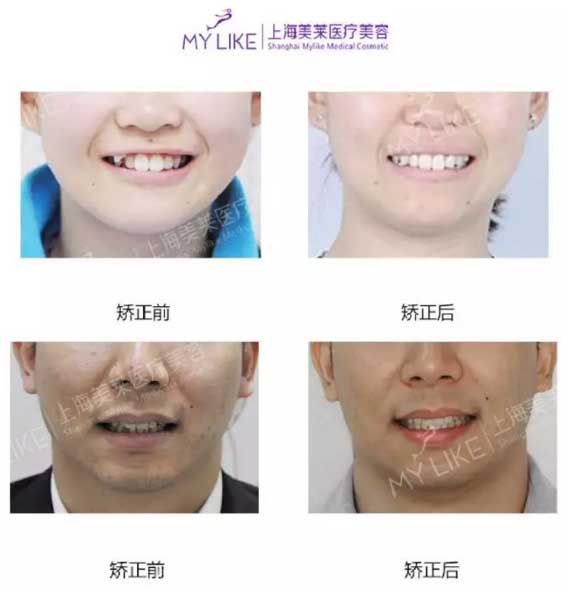 上海美莱口腔科周茹做牙齿怎么样