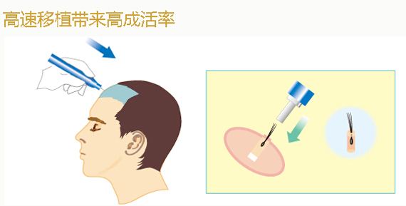 上海美莱种植毛发怎么样