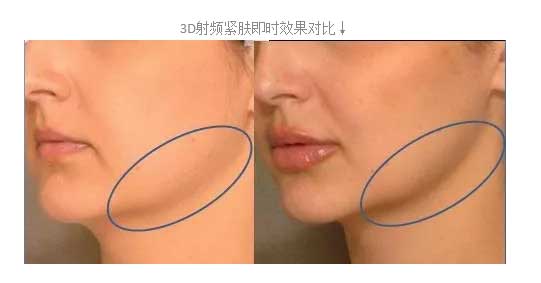 上海美莱射频紧肤对抗皮肤皱纹和松弛