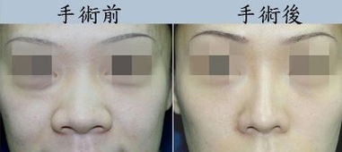 上海做缩鼻孔手术复杂吗