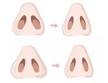 上海做缩鼻孔手术复杂吗