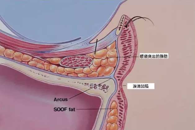 上海填泪沟用再生因子好还是玻尿酸好