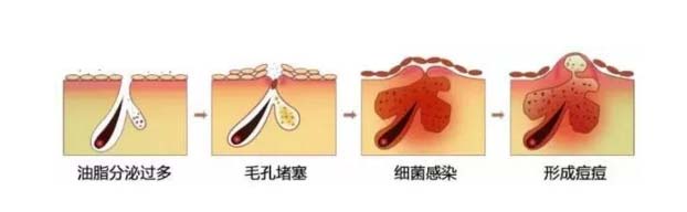 “上海美莱微针”为您调整皮肤水油状态提升皮肤健康度