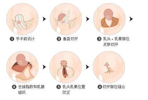 上海做乳形矫正整形医院哪家好