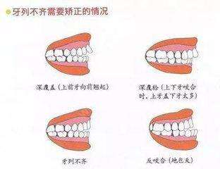 十二岁的孩子适合做牙齿纠正吗