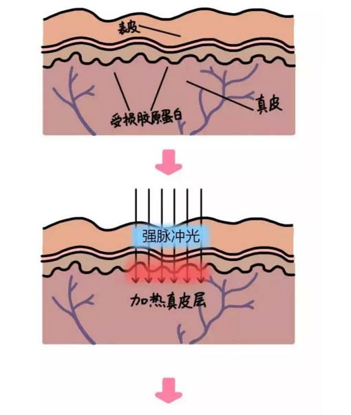 美莱医疗美容光子嫩肤,焕发您肌肤原生态