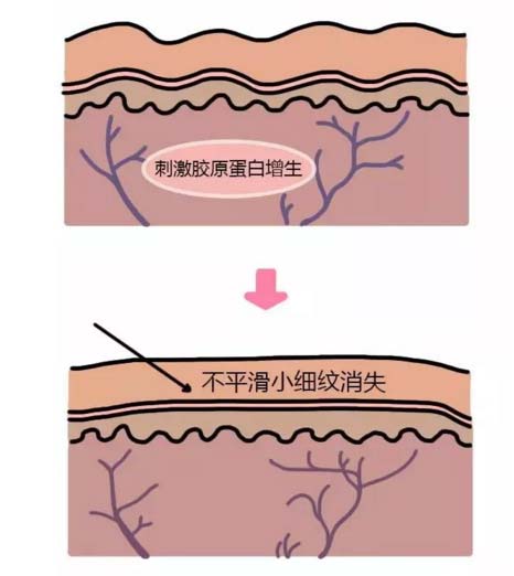 美莱医疗美容光子嫩肤,焕发您肌肤原生态