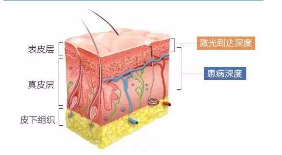 消胎记医院美莱做的好吗