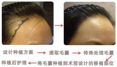在上海做发际线要多少钱