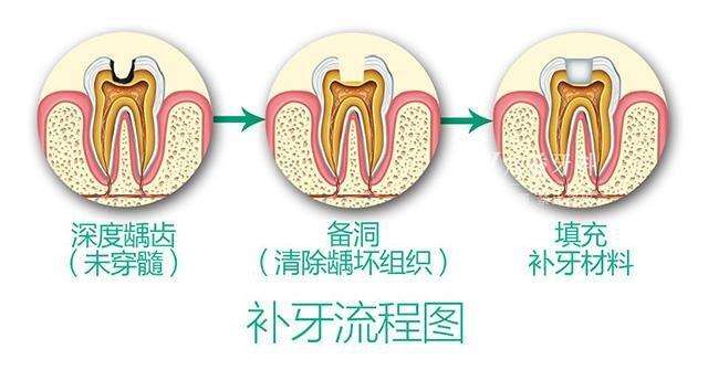 美莱做治疗龋齿要多少钱