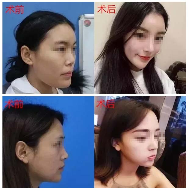 李保锴鼻整形真人案例