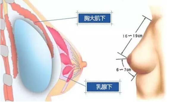 假体丰胸做了会影响哺乳吗