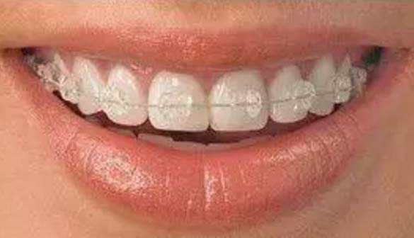 美莱口腔美容张国栋介绍牙齿矫正器有哪些