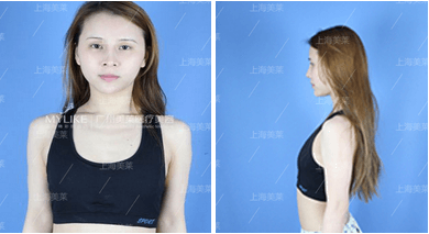 cici科尔曼脂肪丰胸