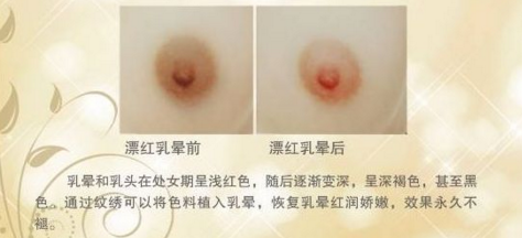 上海做乳晕漂红有风险吗