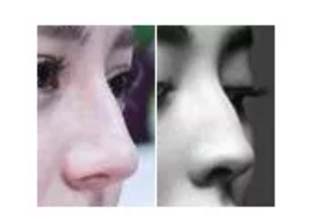 上海美莱隆鼻欧阳春为您揭秘:驼峰鼻男女差异