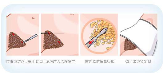 腰腹部吸脂失败该怎么办，上海怎么做修复