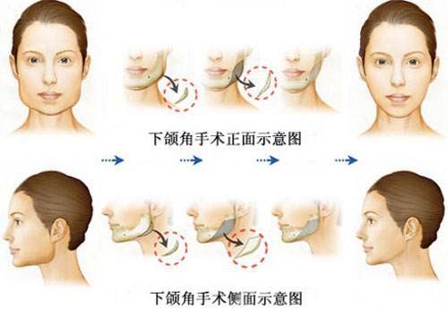 改脸型，注射瘦脸和磨骨哪个方法更好
