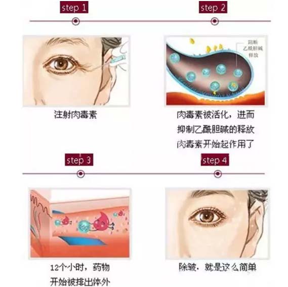 上海美莱揭秘:玻尿酸和注射瘦脸可以同时打吗