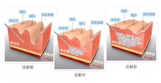 上海美莱揭秘:玻尿酸和注射瘦脸可以同时打吗