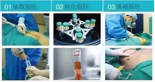 美莱自体脂肪移植丰胸