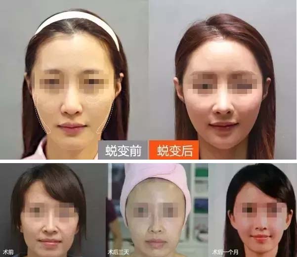 美莱自体脂肪丰面颊