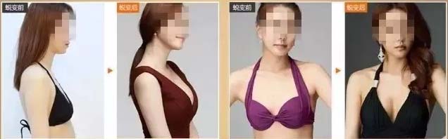 美莱自体脂肪丰胸