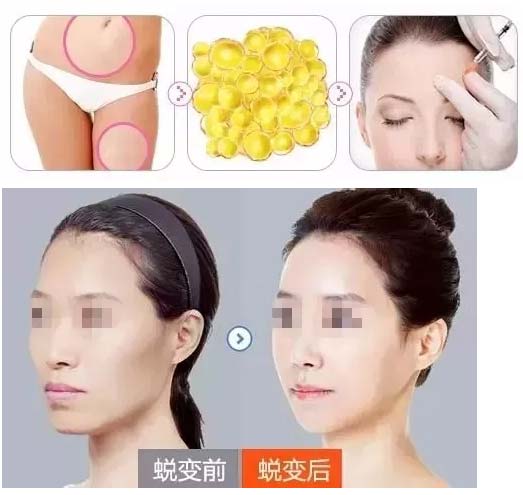 美莱自体脂肪丰额头