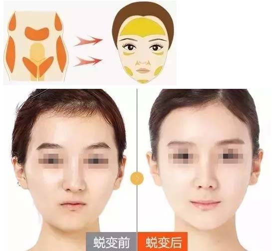 美莱自体脂肪丰太阳穴