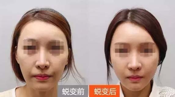 美莱自体脂肪填充鼻唇沟