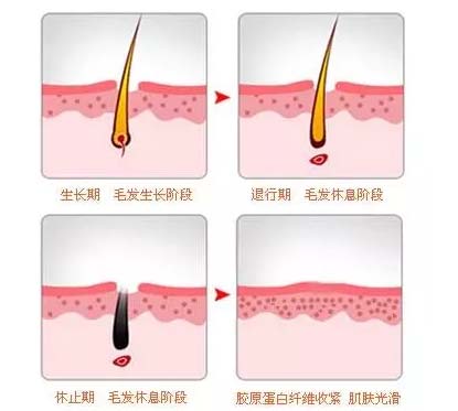 美莱激光脱唇毛间隔时间要多久