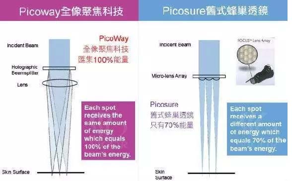 上海美莱picoway超皮秒去除雀斑效果好吗