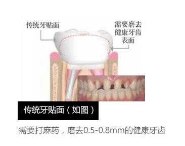 上海做超薄牙贴面哪家好