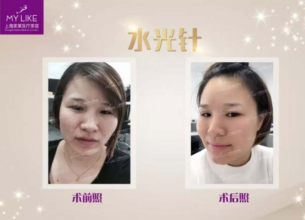 美莱水光全效拯救我们被晒黑肌肤