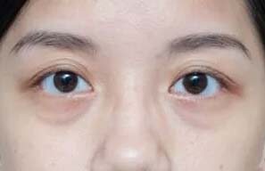 美莱脂肪突出型