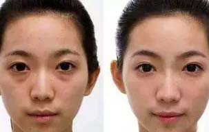 美莱假性黑眼圈型