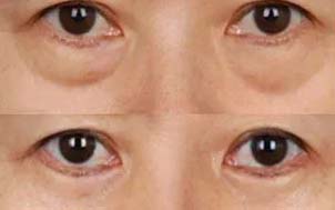 美莱眼周皱纹+轻度松弛型圈型