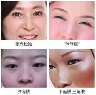 上海美莱三大术式塑造魅力双眸