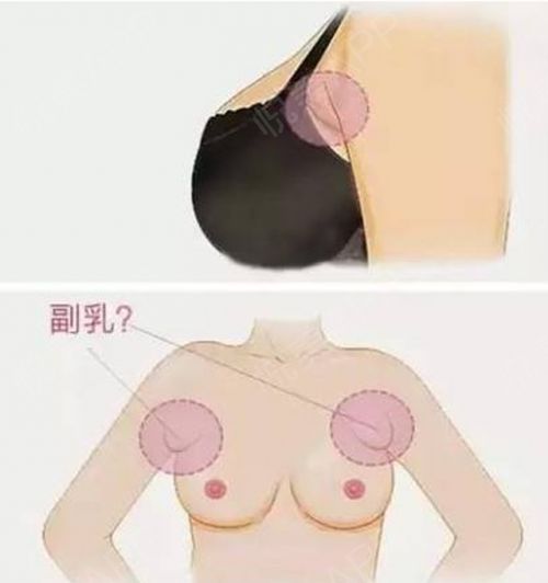 在上海做副乳手术要多少钱