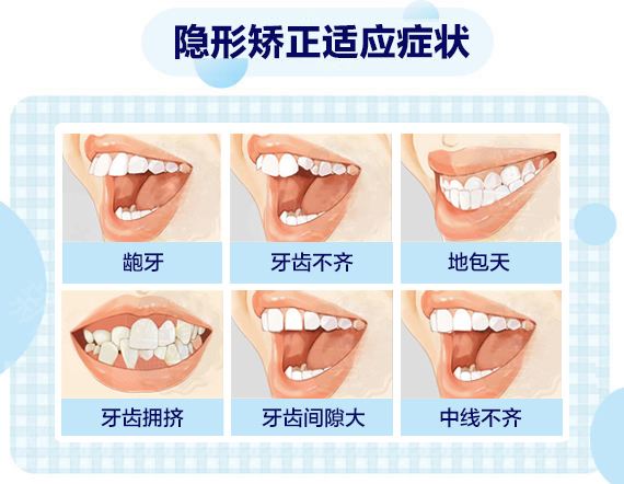 上海做龅牙牙齿矫正需要多少钱