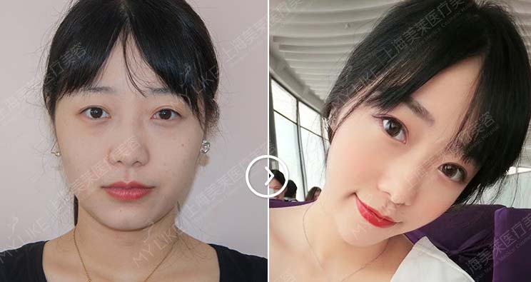上海美莱埋线双眼皮手术案例
