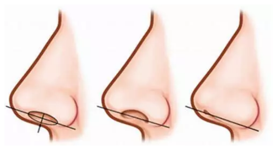 上海美莱鼻整形专家团丨暑期鼻整形攻略：让你对你的鼻子爱到不行！