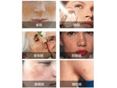 告别“斑”女郎，洁白无瑕女神脸轻松拥有！