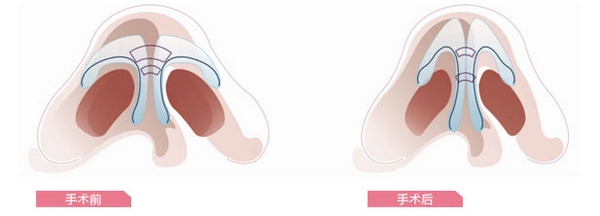 鼻翼缩小手术哪家医院好