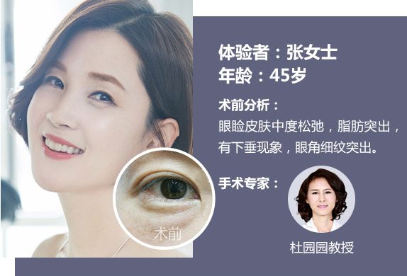 美莱祛眼袋体验者