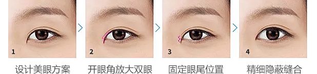 上海做开眼角整形费用多少钱