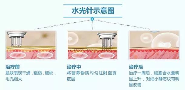 想要深层次补水，上海美莱水光了解一下！