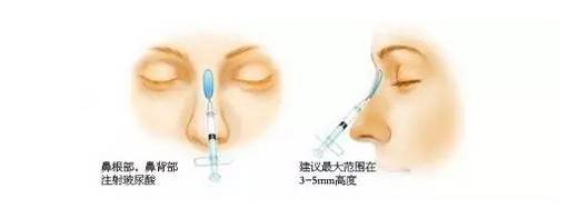 上海隆鼻的方式有哪些