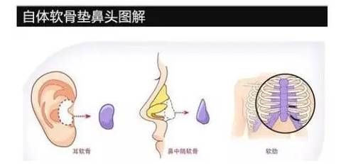 上海隆鼻的方式有哪些