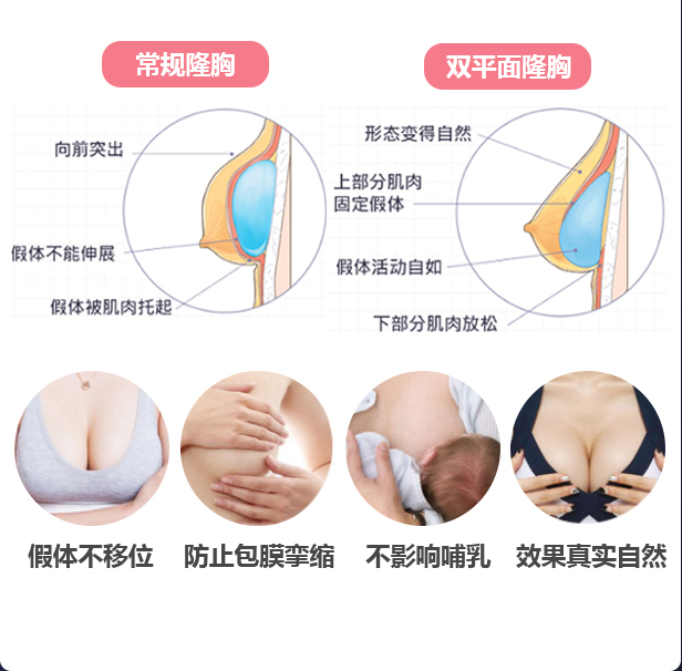 上海美莱医院假体丰胸方法有哪些